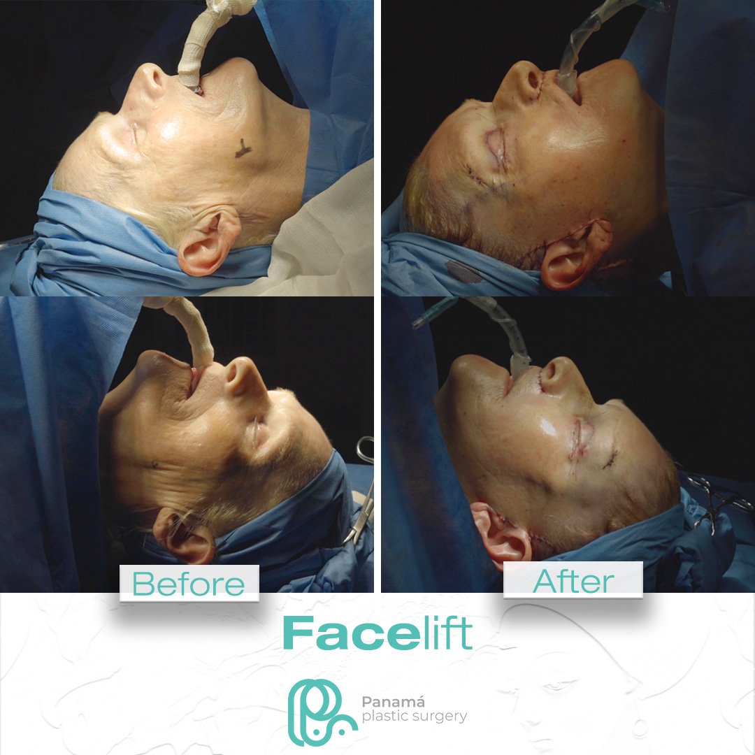Facelift in Cancun Mexico. Dr. Patricia Panamá. Plastic Surgeon in Mexico (3)