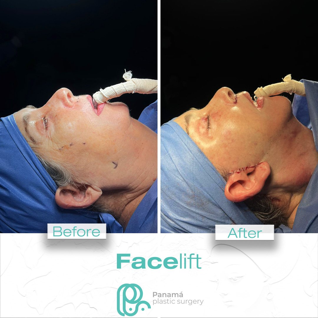 Facelift in Cancun Mexico. Dr. Patricia Panamá. Plastic Surgeon in Mexico (4)