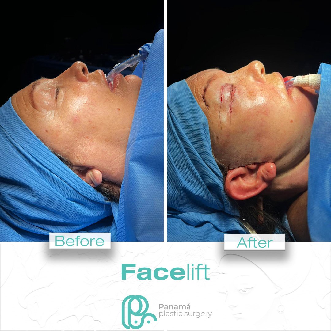 Facelift in Cancun Mexico. Dr. Patricia Panamá. Plastic Surgeon in Mexico (5)