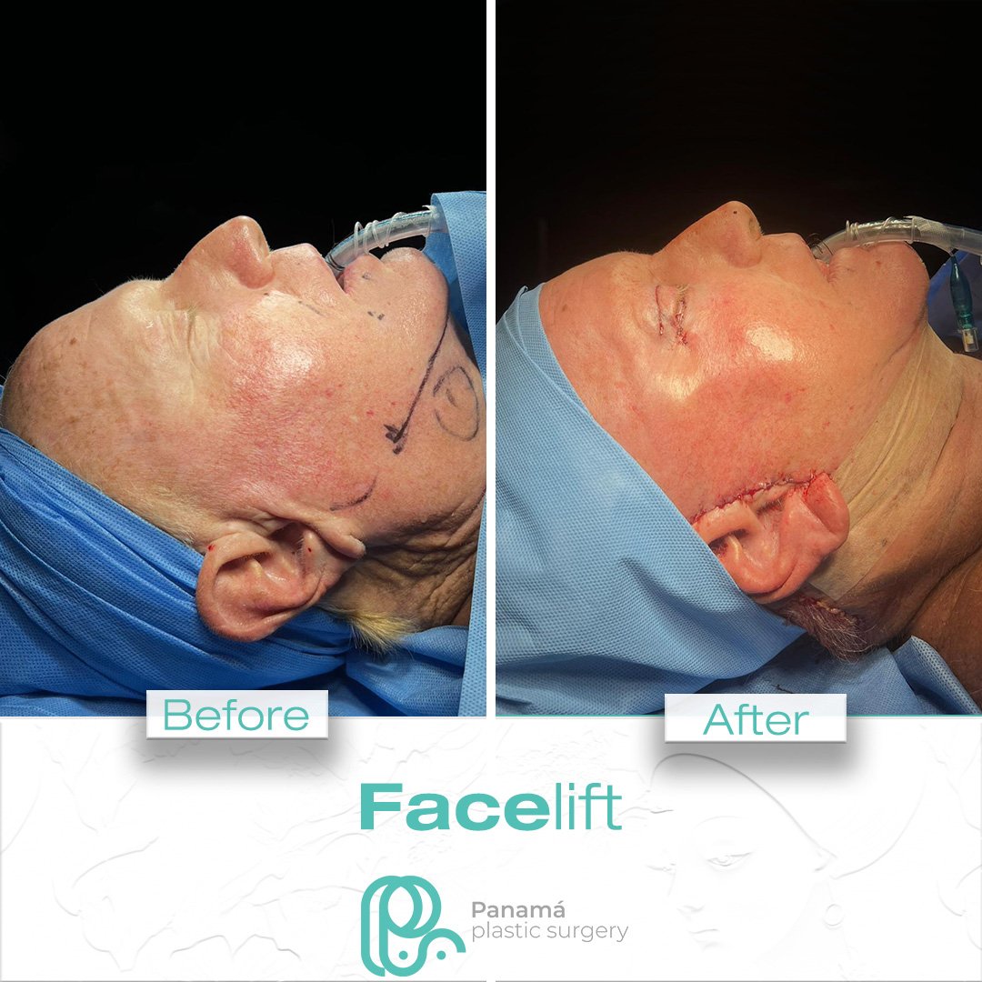 Facelift in Cancun Mexico. Dr. Patricia Panamá. Plastic Surgeon in Mexico (7)