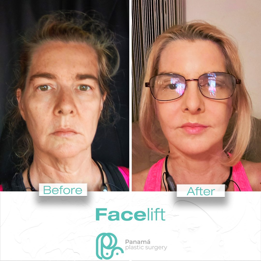 Facelift in Cancun Mexico. Dr. Patricia Panamá. Plastic Surgeon in Mexico (8)