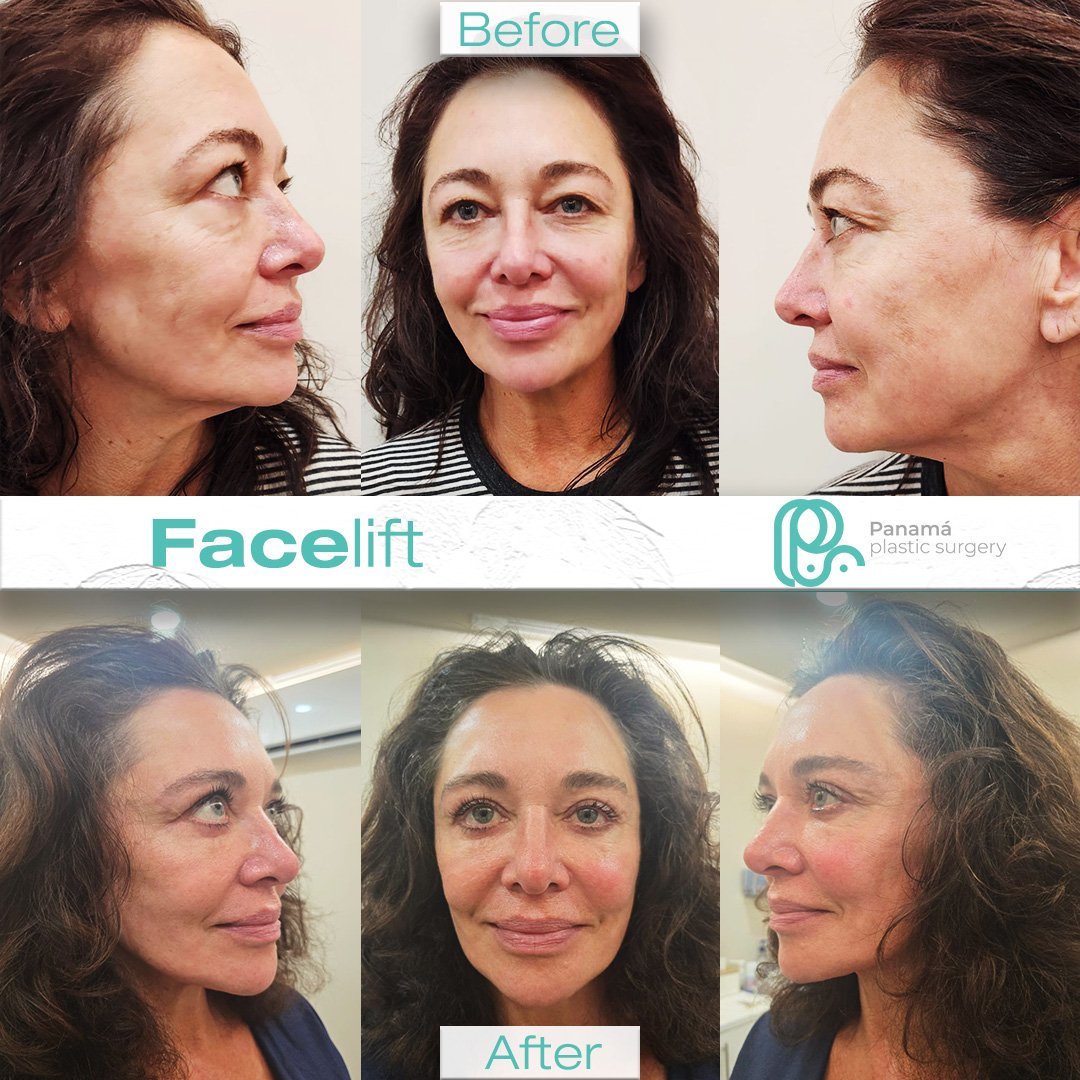 Facelift in Cancun Mexico. Dr. Patricia Panamá. Plastic Surgeon in Mexico (9)