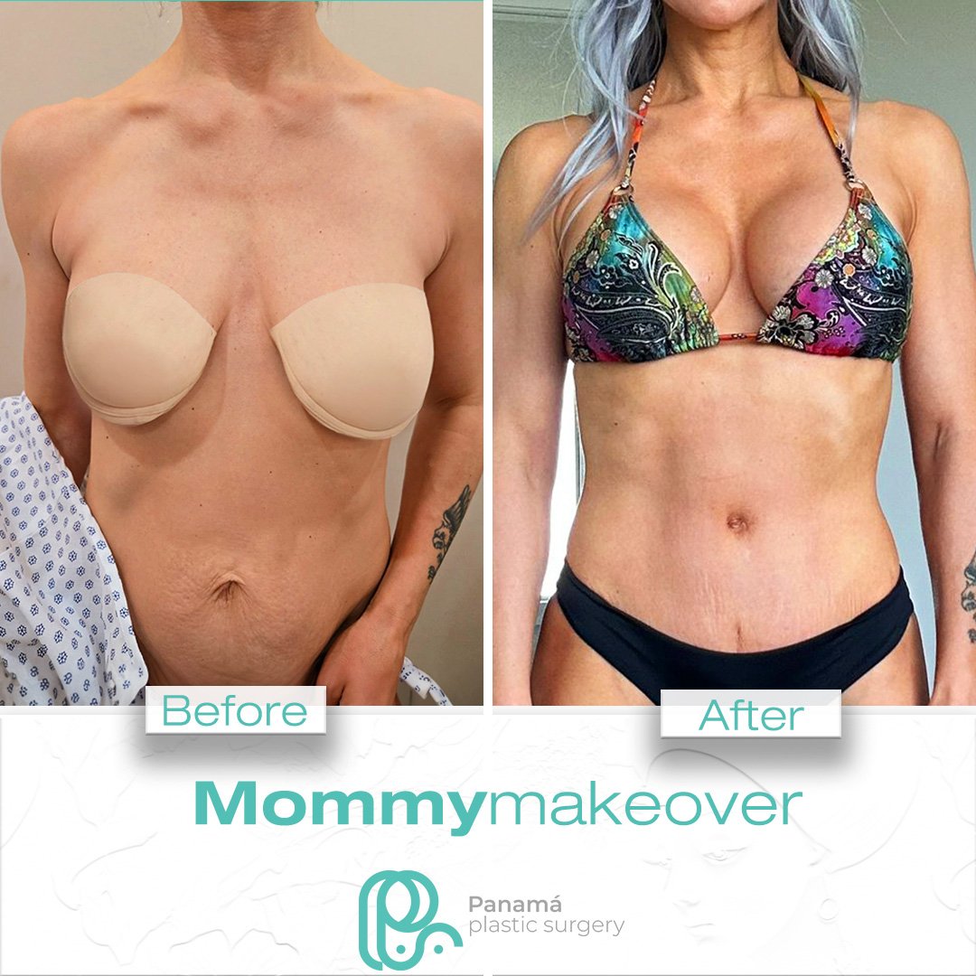 Mommy Makeover in Mexico. Dr Patricia Panamá. Plastic Surgeon in Cancun Mexico (10)