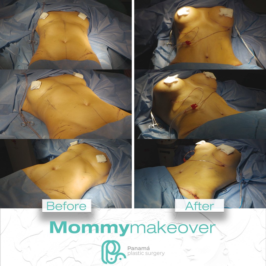 Mommy Makeover in Mexico. Dr Patricia Panamá. Plastic Surgeon in Cancun Mexico (11)