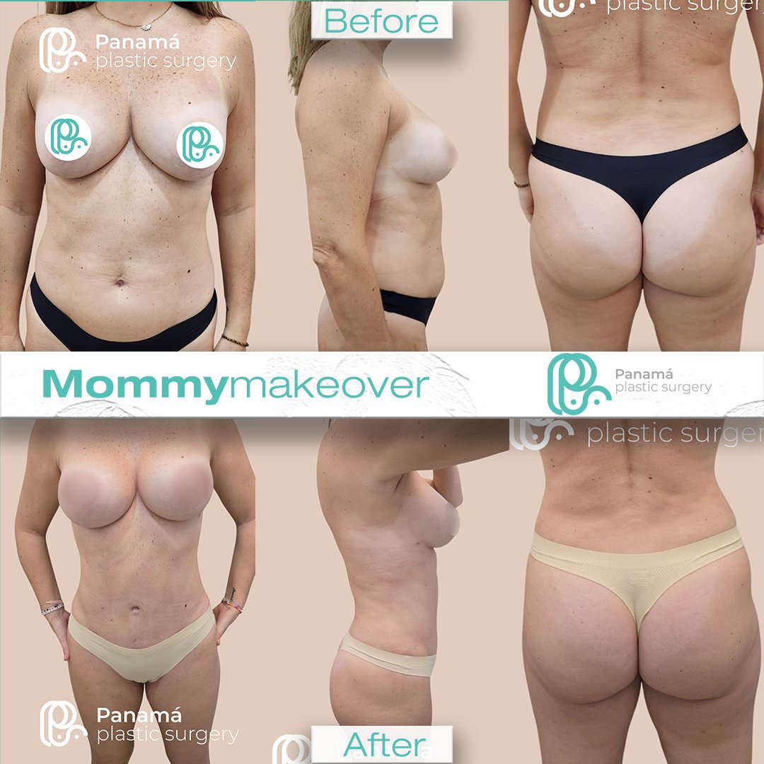 Mommy Makeover in Mexico. Dr Patricia Panamá. Plastic Surgeon in Cancun Mexico (13)