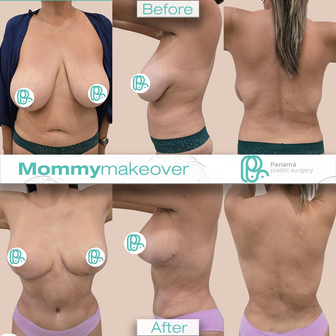 Mommy Makeover in Mexico. Dr Patricia Panamá. Plastic Surgeon in Cancun Mexico (14)