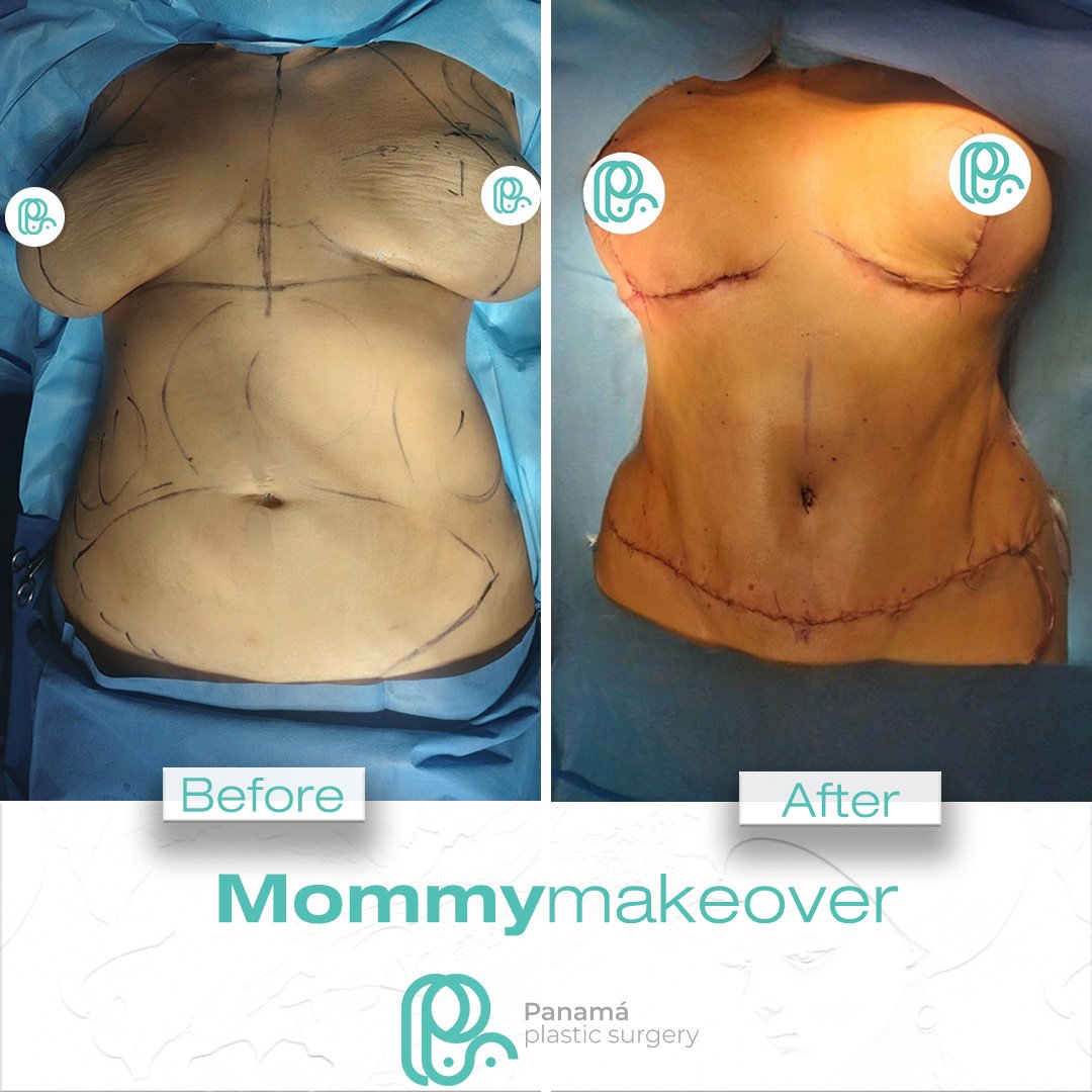 Mommy Makeover in Mexico. Dr Patricia Panamá. Plastic Surgeon in Cancun Mexico (15)