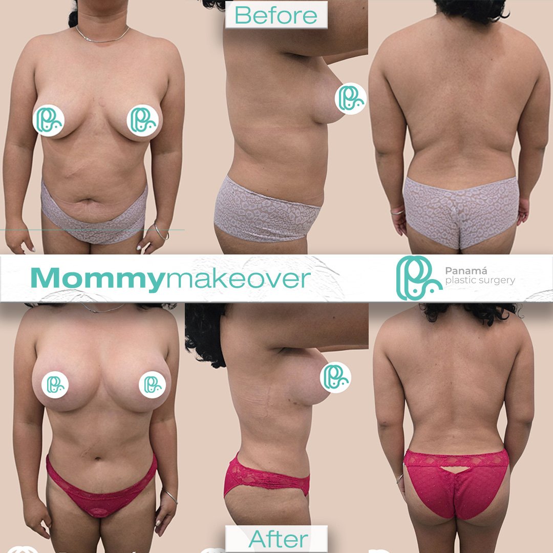 Mommy Makeover in Mexico. Dr Patricia Panamá. Plastic Surgeon in Cancun Mexico (16)