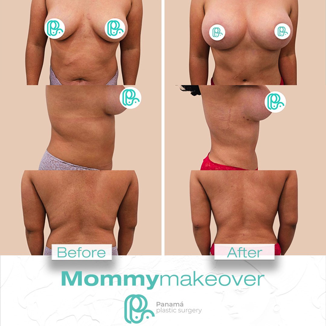 Mommy Makeover in Mexico. Dr Patricia Panamá. Plastic Surgeon in Cancun Mexico (17)