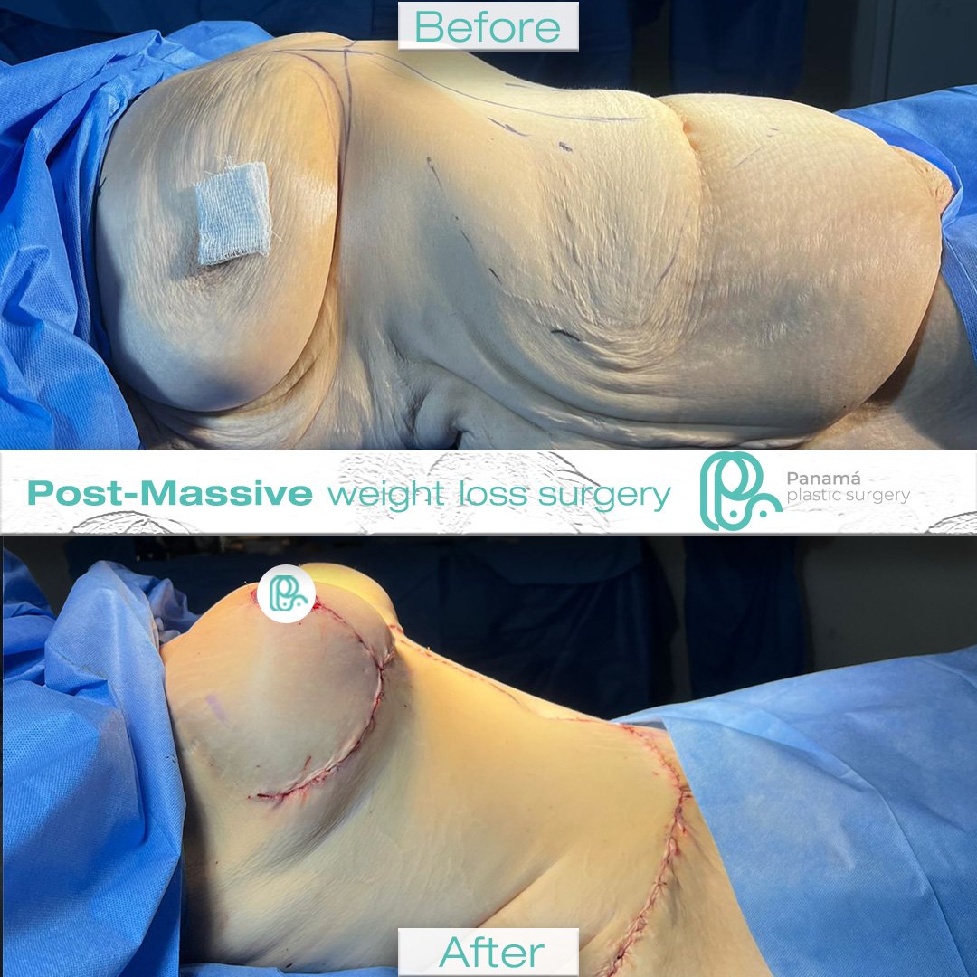 Mommy Makeover in Mexico. Dr Patricia Panamá. Plastic Surgeon in Cancun Mexico (18)