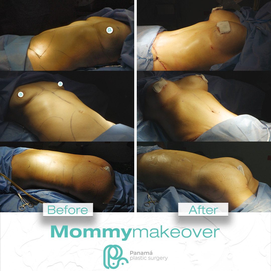 Mommy Makeover in Mexico. Dr Patricia Panamá. Plastic Surgeon in Cancun Mexico (6)