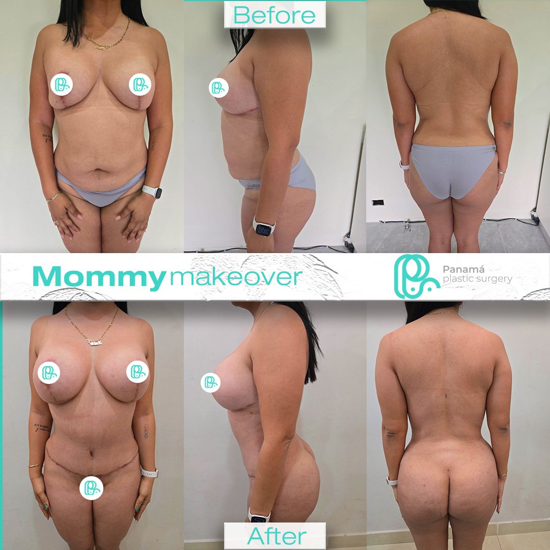 Mommy Makeover in Mexico. Dr Patricia Panamá. Plastic Surgeon in Cancun Mexico (7)