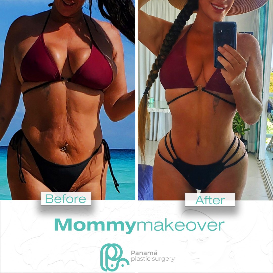 Mommy Makeover in Mexico. Dr Patricia Panamá. Plastic Surgeon in Cancun Mexico (8)