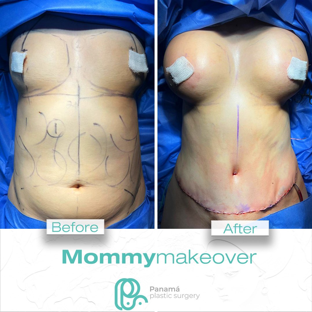 Mommy Makeover in Mexico. Dr Patricia Panamá. Plastic Surgeon in Cancun Mexico (9)