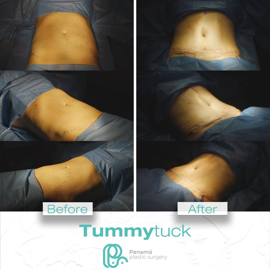 Tummy Tuck in Cancun Mexico. Dr. Patricia Panamá (2)