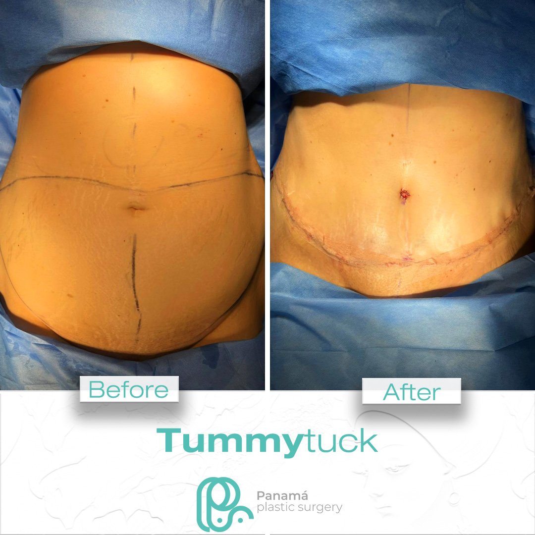 Tummy Tuck in Cancun Mexico. Dr. Patricia Panamá (3)