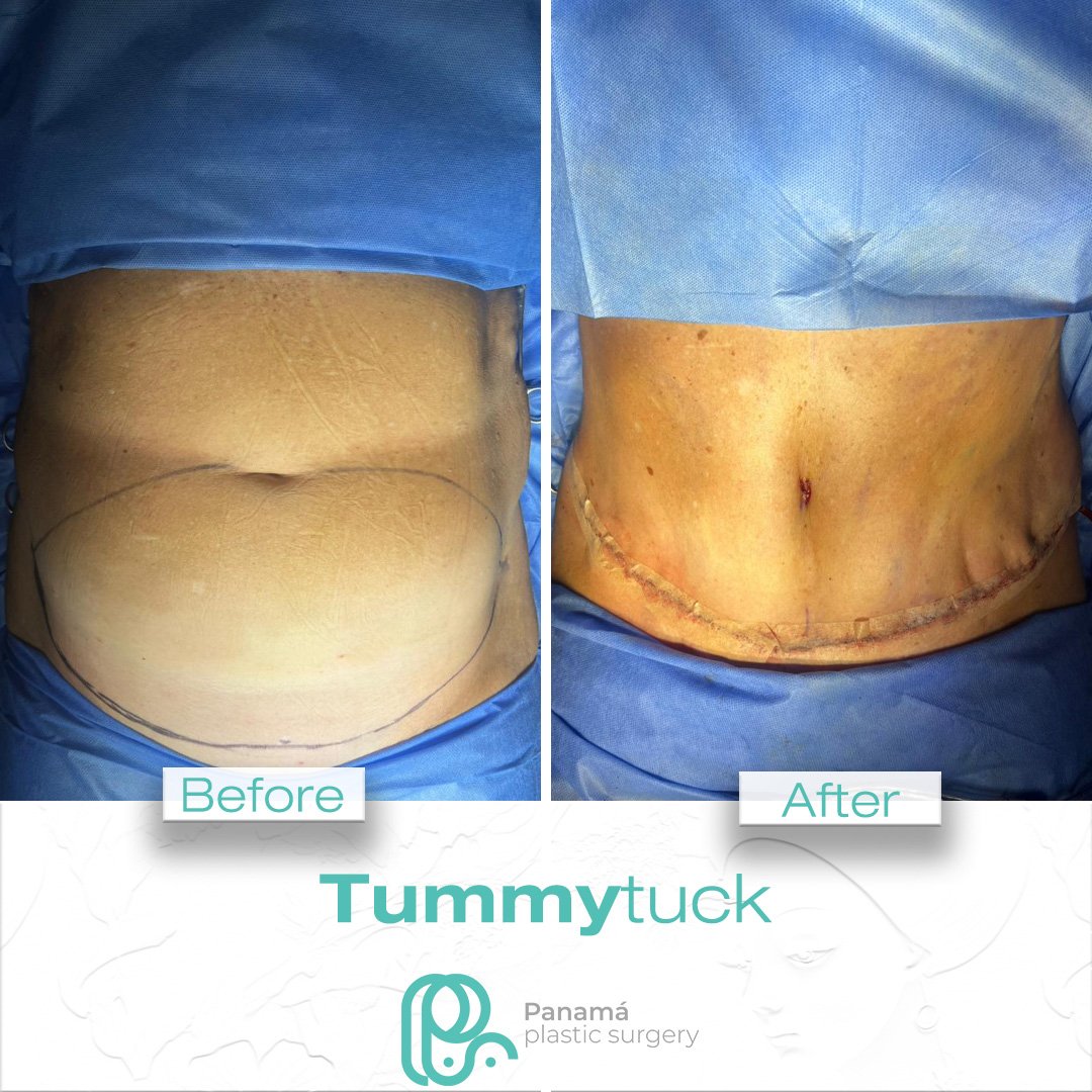 Tummy Tuck in Cancun Mexico. Dr. Patricia Panamá (4)